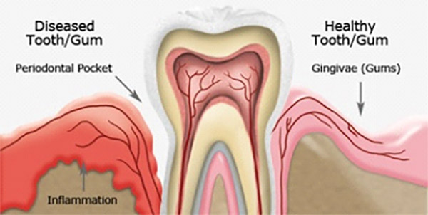 Periodontal Care